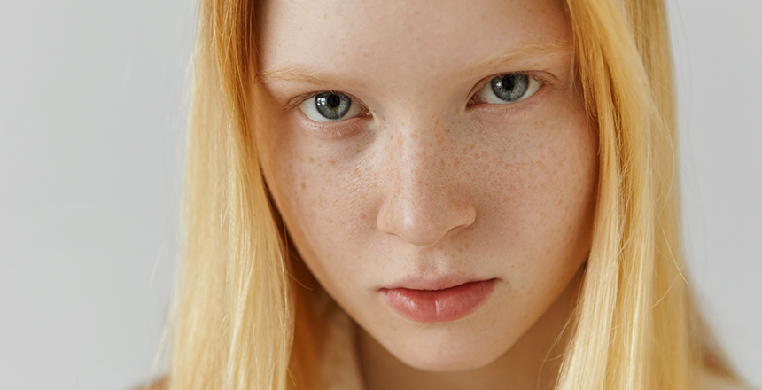 Фото - Гиперпигментация кожи