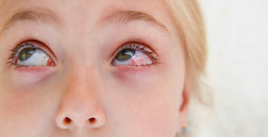 Конъюнктивит у детей 