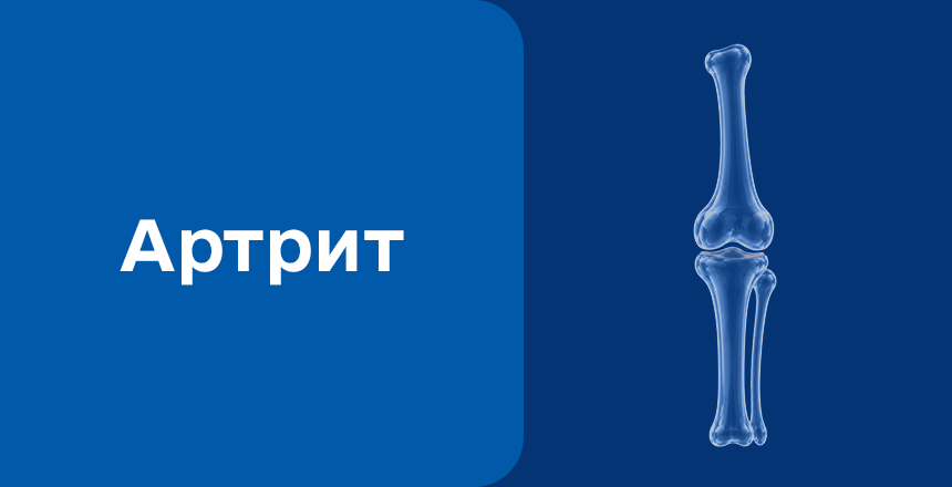Фото - Артрит: причины, симптомы и современная диагностика