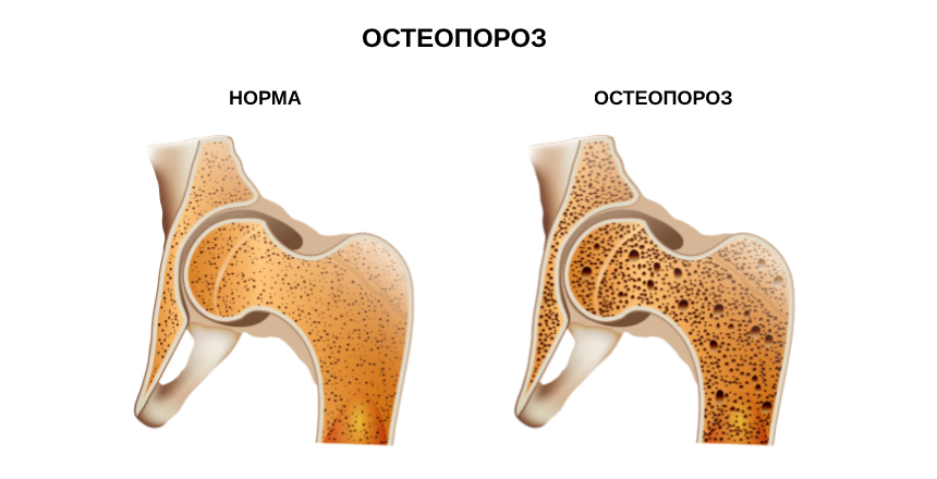 Фото - Новое исследование для оценки состояния костной ткани 